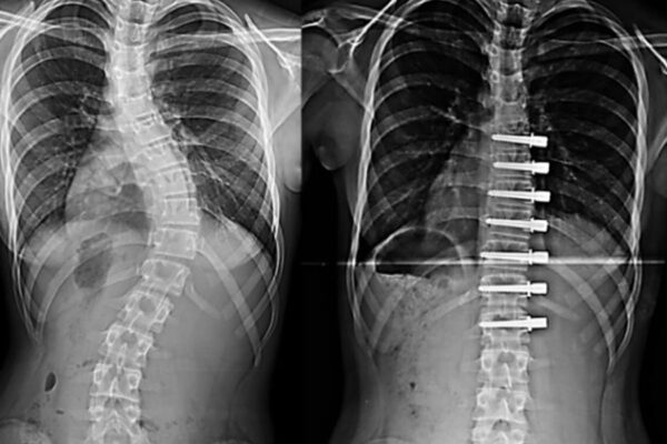 Vertebral Body Tethering (VBT)