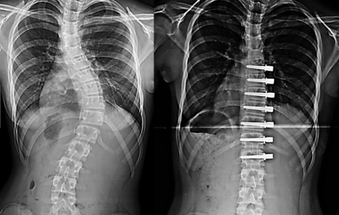Vertebral Body Tethering (VBT)