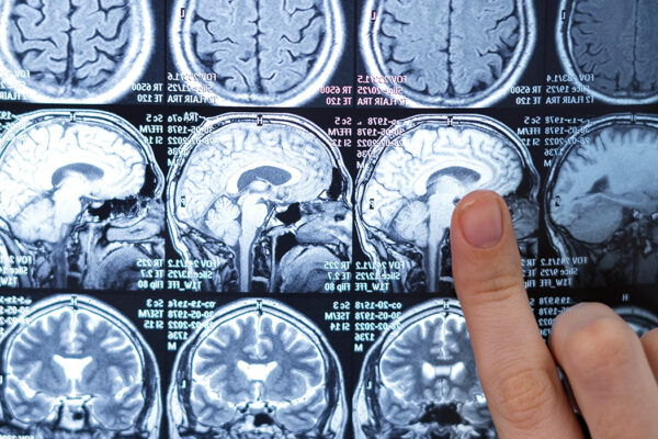 Brain Tumor