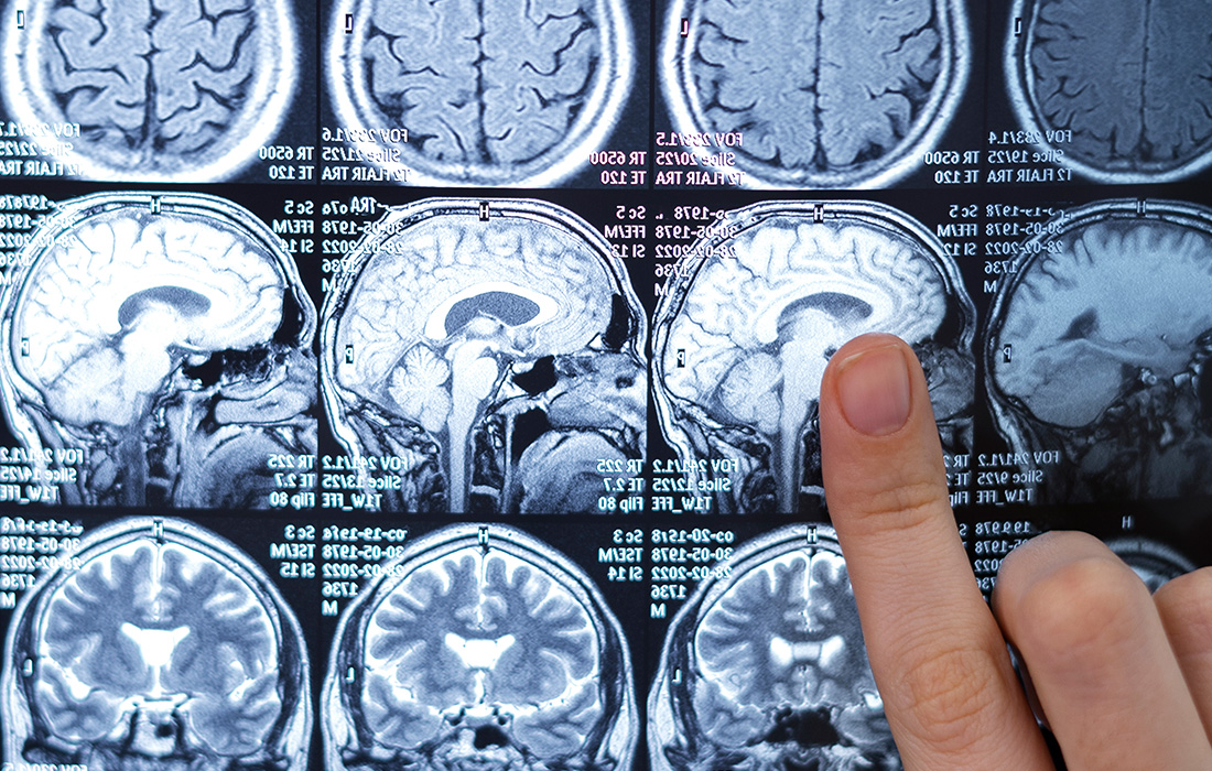 Brain Tumor
