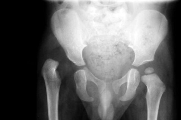 Hip Dislocation