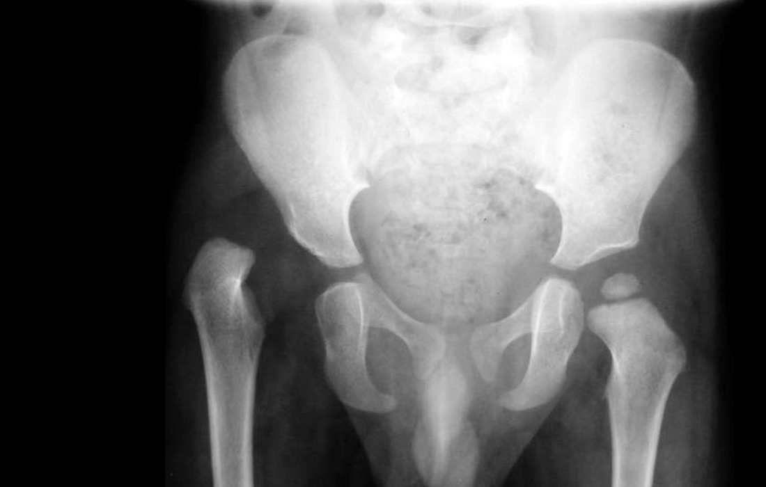 Hip Dislocation