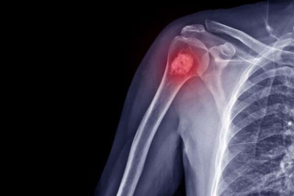 Orthopaedic Tumor
