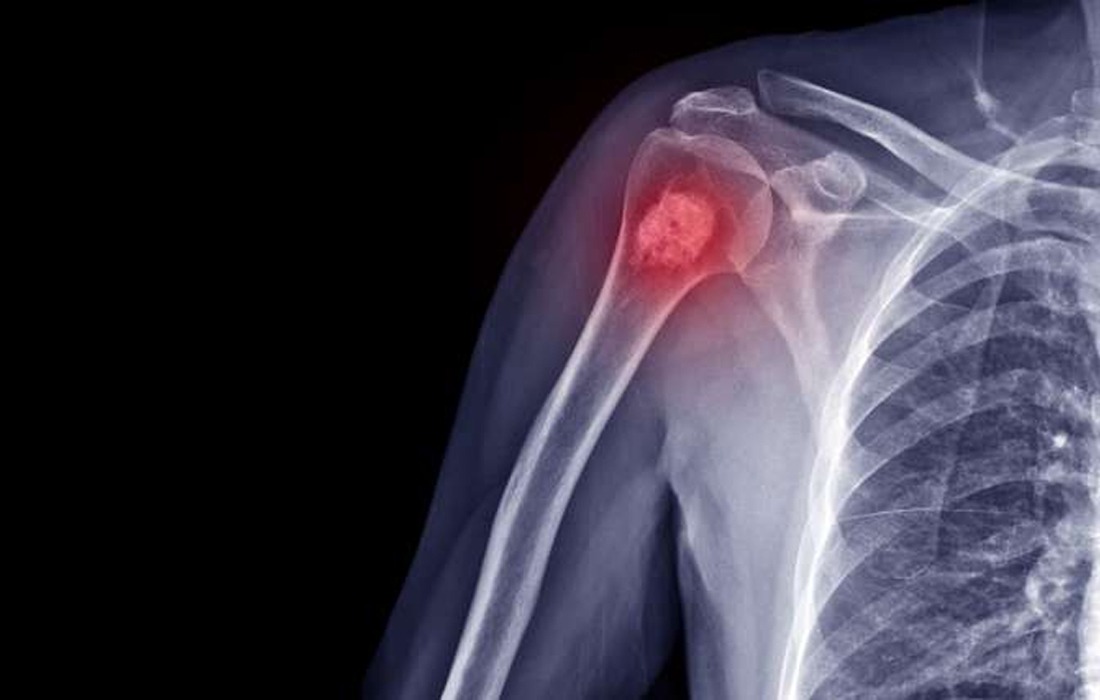 Orthopaedic Tumor