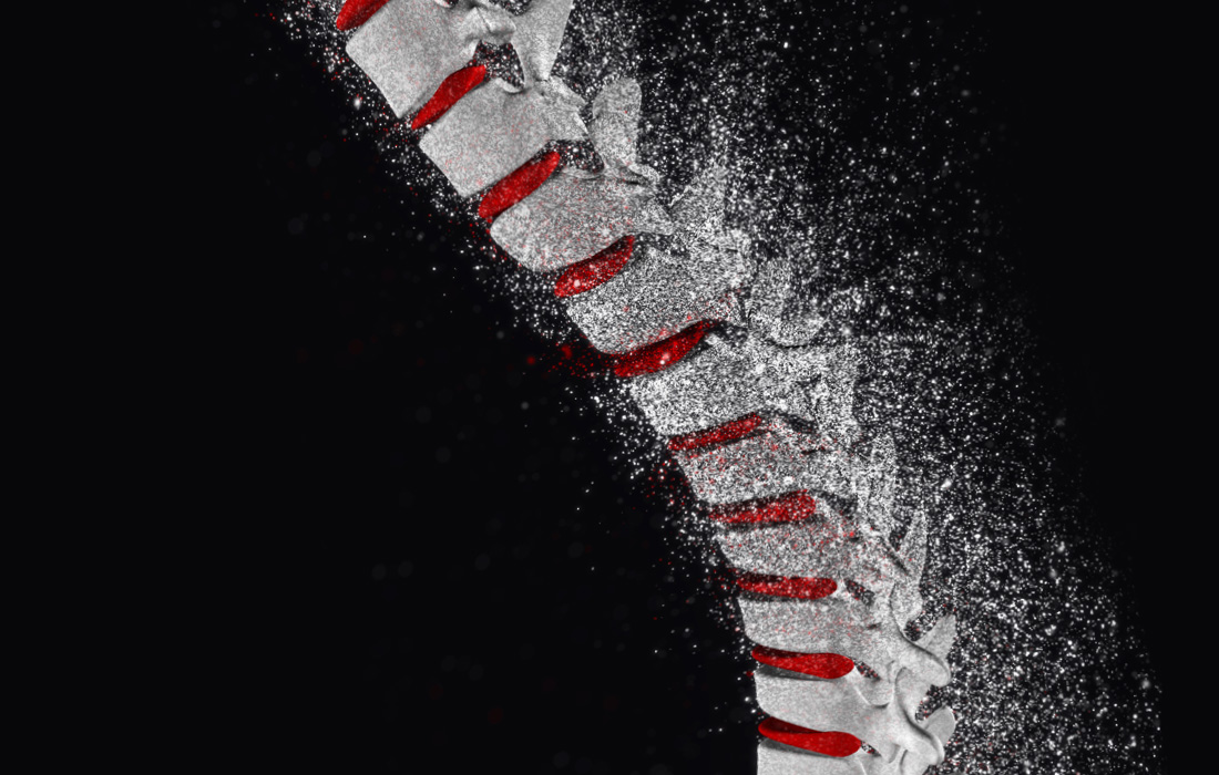 Spinal Cord Stimulation