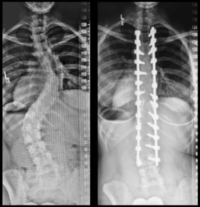 Spinal Fusion Image