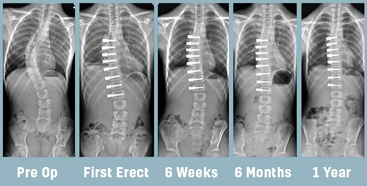 VBT Surgery Images