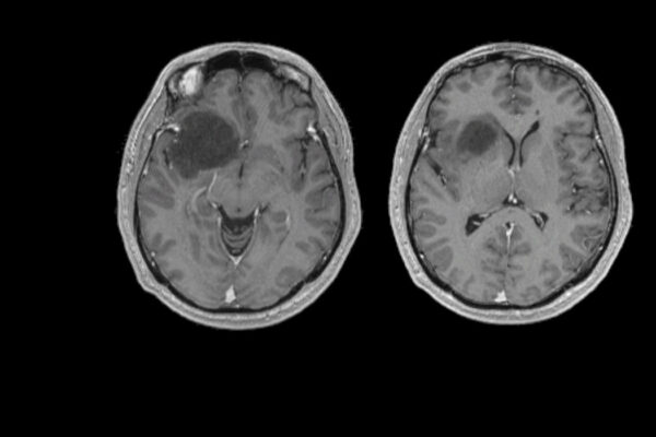 Glioma