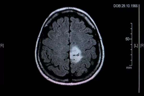 metastatic brain tumors diagnosis