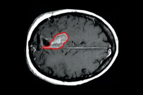 MR Linac Therapy Effect